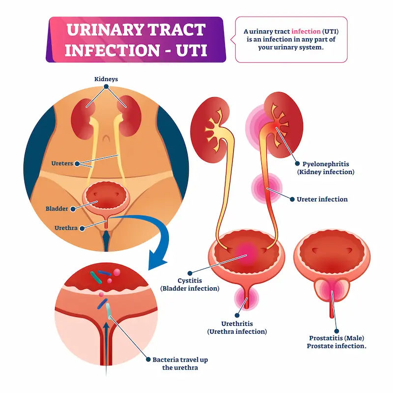 Urinary Tract Infection Overview